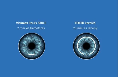 Mivel tud többet a negyedik generációs VISUMAX ReLEx SMILE®? Mivel tud többet a negyedik generációs VISUMAX ReLEx SMILE®?