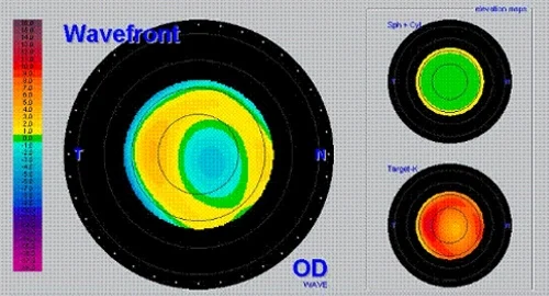 Aberrométer (hullámfront-mérő) készülék