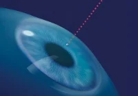 FEMTO kezelés illusztráció 1