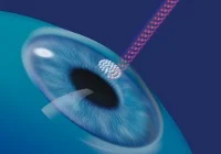 FEMTO kezelés illusztráció 2