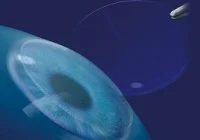 FEMTO kezelés illusztráció 3