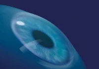 FEMTO kezelés illusztráció 4